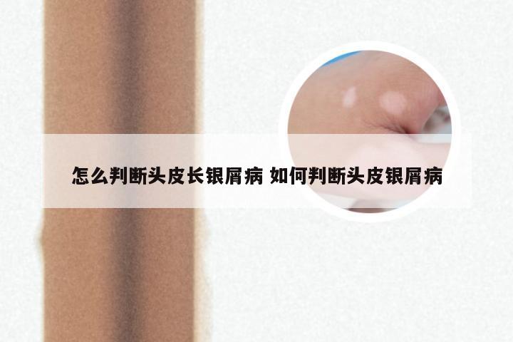 怎么判断头皮长银屑病 如何判断头皮银屑病