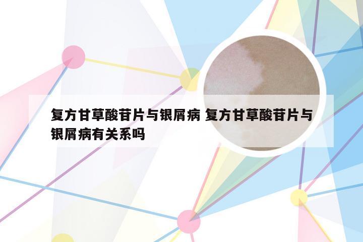 复方甘草酸苷片与银屑病 复方甘草酸苷片与银屑病有关系吗