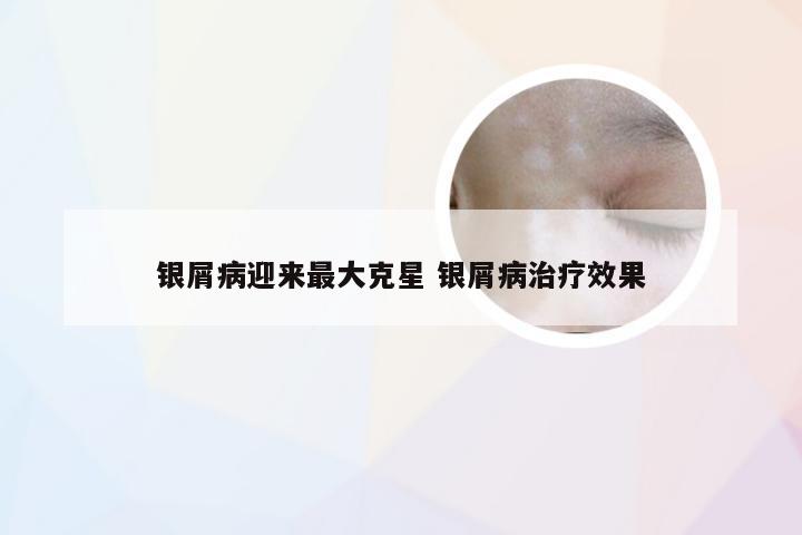 银屑病迎来最大克星 银屑病治疗效果