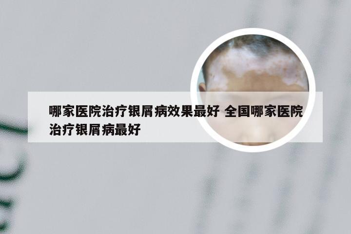哪家医院治疗银屑病效果最好 全国哪家医院治疗银屑病最好