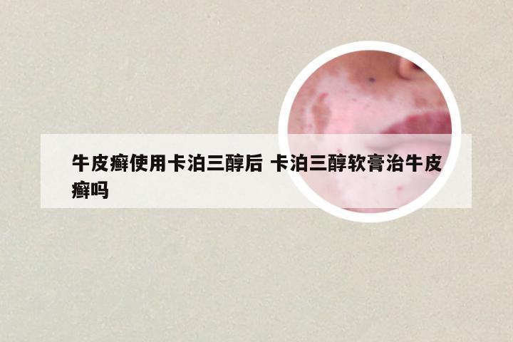 牛皮癣使用卡泊三醇后 卡泊三醇软膏治牛皮癣吗