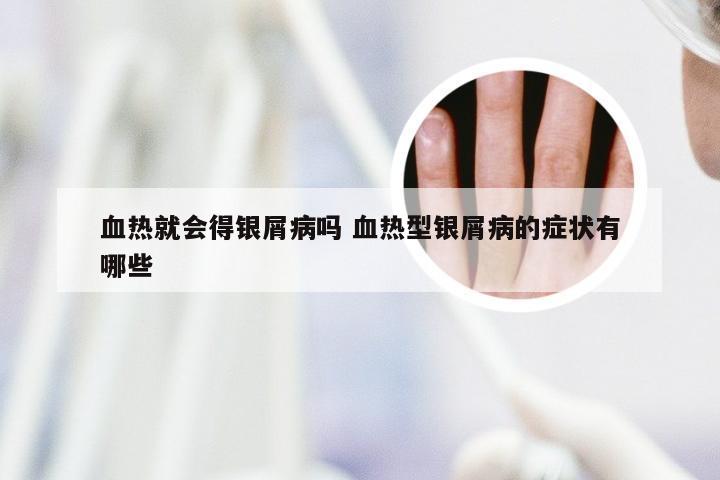 血热就会得银屑病吗 血热型银屑病的症状有哪些