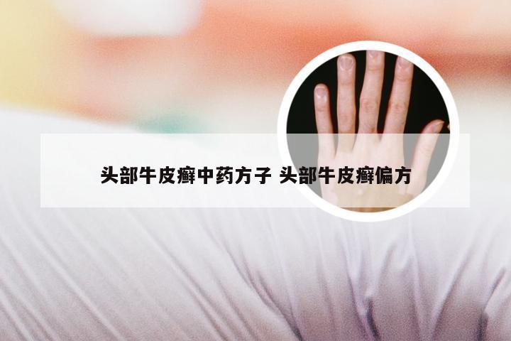 头部牛皮癣中药方子 头部牛皮癣偏方