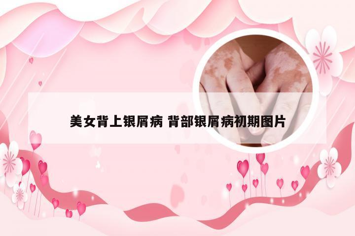美女背上银屑病 背部银屑病初期图片