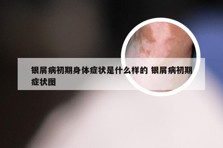银屑病初期身体症状是什么样的 银屑病初期症状图