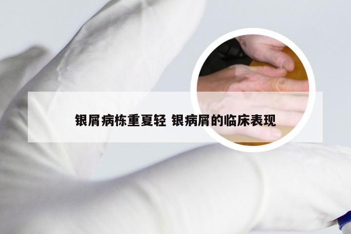 银屑病栋重夏轻 银病屑的临床表现