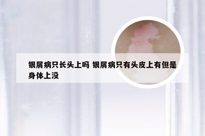 银屑病只长头上吗 银屑病只有头皮上有但是身体上没