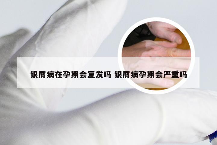 银屑病在孕期会复发吗 银屑病孕期会严重吗