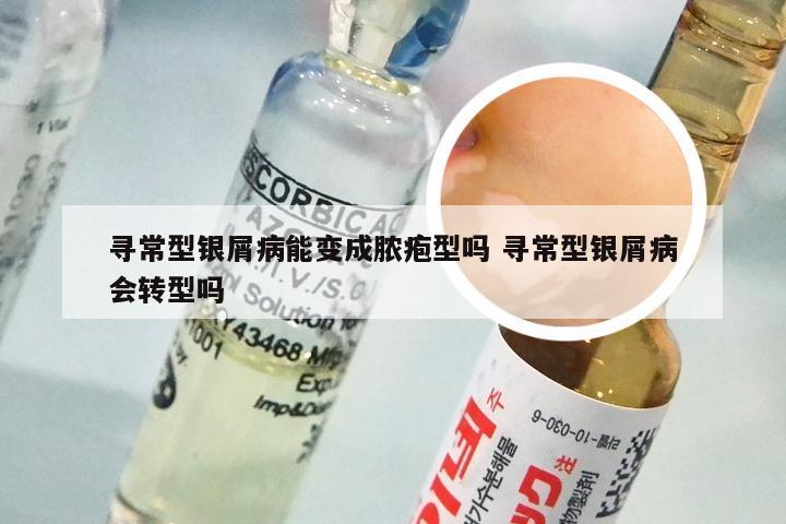 寻常型银屑病能变成脓疱型吗 寻常型银屑病会转型吗