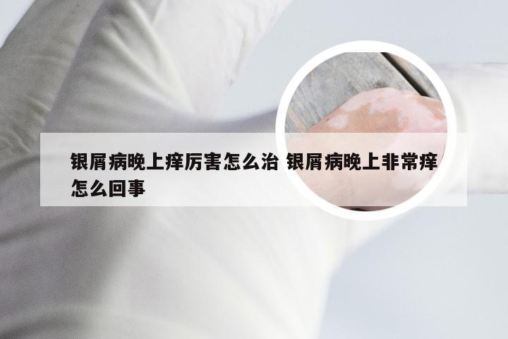 银屑病晚上痒厉害怎么治 银屑病晚上非常痒怎么回事