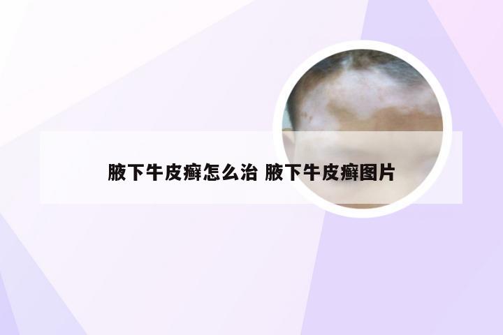 腋下牛皮癣怎么治 腋下牛皮癣图片