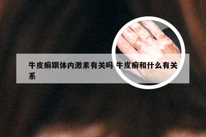 牛皮癣跟体内激素有关吗 牛皮癣和什么有关系