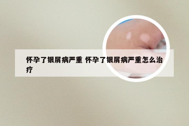 怀孕了银屑病严重 怀孕了银屑病严重怎么治疗