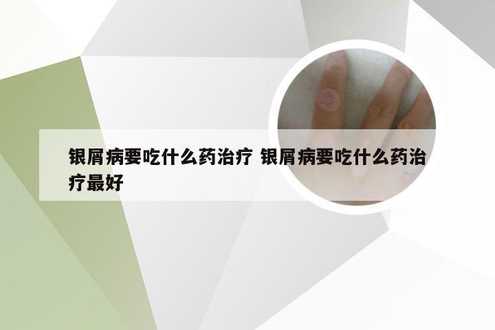 银屑病要吃什么药治疗 银屑病要吃什么药治疗最好