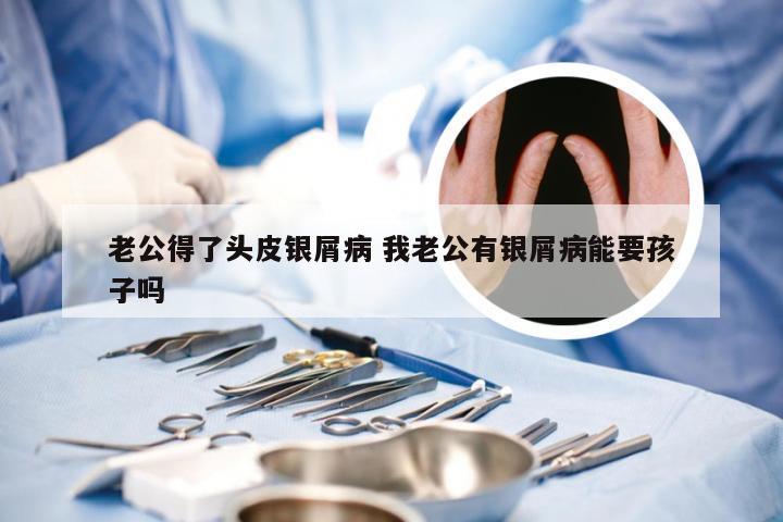 老公得了头皮银屑病 我老公有银屑病能要孩子吗