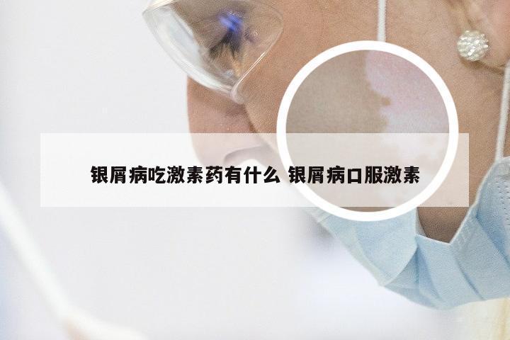 银屑病吃激素药有什么 银屑病口服激素
