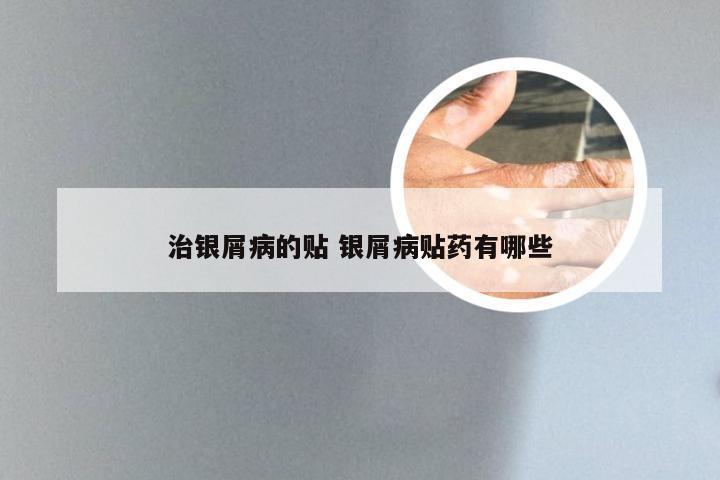 治银屑病的贴 银屑病贴药有哪些