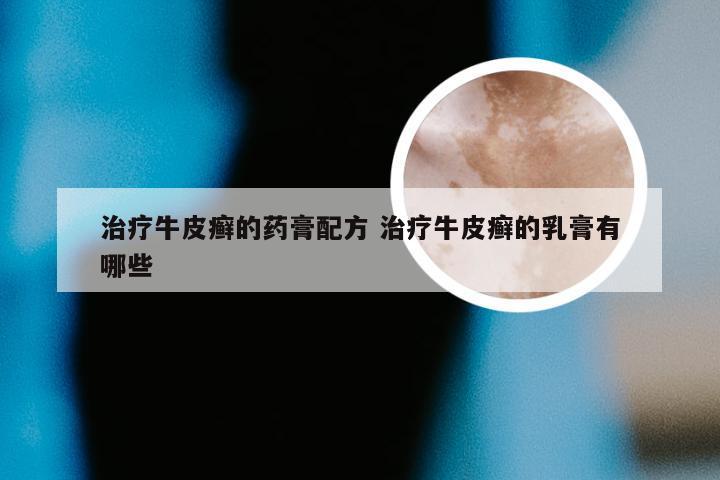 治疗牛皮癣的药膏配方 治疗牛皮癣的乳膏有哪些