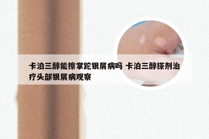 卡泊三醇能擦掌跎银屑病吗 卡泊三醇搽剂治疗头部银屑病观察