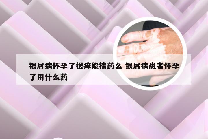 银屑病怀孕了很痒能擦药么 银屑病患者怀孕了用什么药
