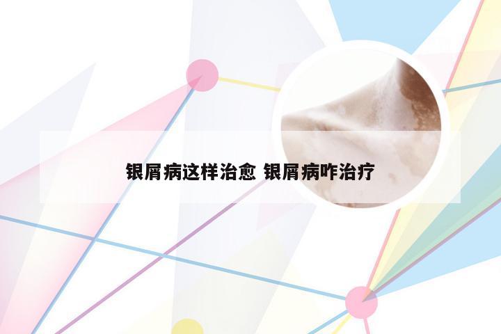银屑病这样治愈 银屑病咋治疗