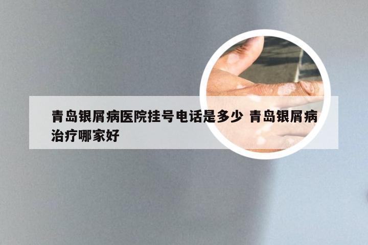 青岛银屑病医院挂号电话是多少 青岛银屑病治疗哪家好