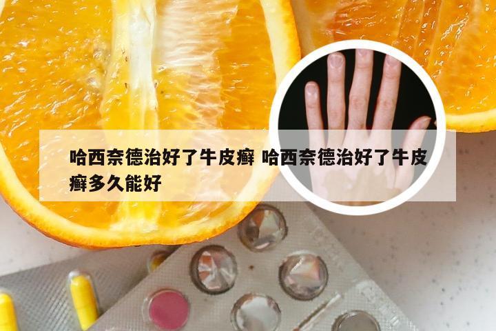 哈西奈德治好了牛皮癣 哈西奈德治好了牛皮癣多久能好