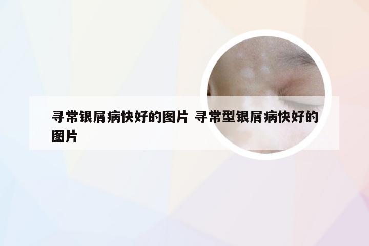 寻常银屑病快好的图片 寻常型银屑病快好的图片