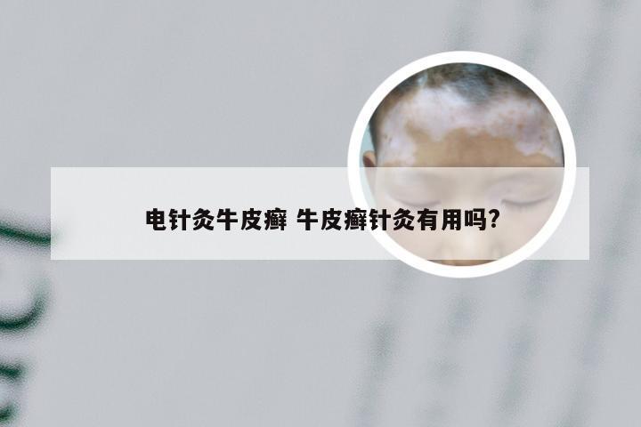 电针灸牛皮癣 牛皮癣针灸有用吗?