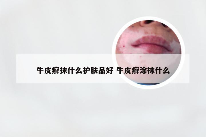 牛皮癣抹什么护肤品好 牛皮癣涂抹什么