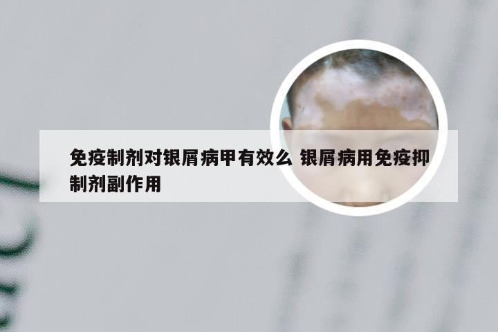 免疫制剂对银屑病甲有效么 银屑病用免疫抑制剂副作用
