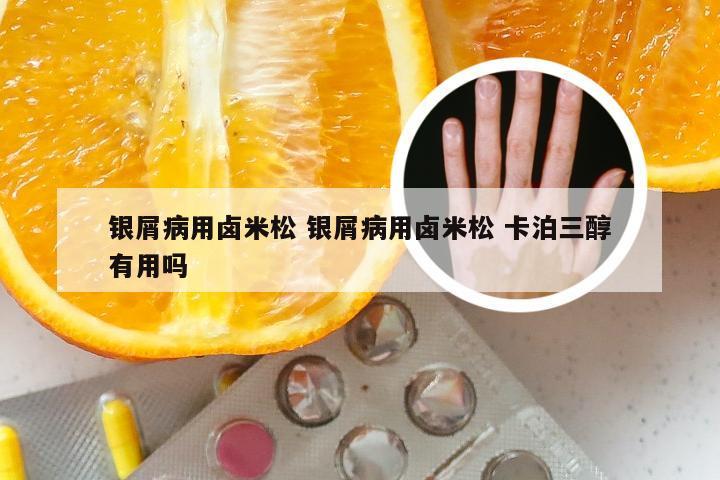 银屑病用卤米松 银屑病用卤米松 卡泊三醇有用吗
