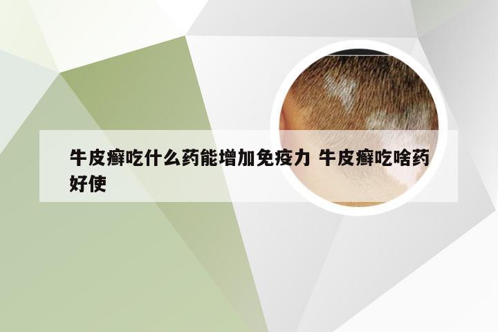 牛皮癣吃什么药能增加免疫力 牛皮癣吃啥药好使