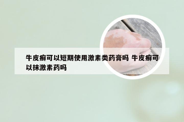 牛皮癣可以短期使用激素类药膏吗 牛皮癣可以抹激素药吗