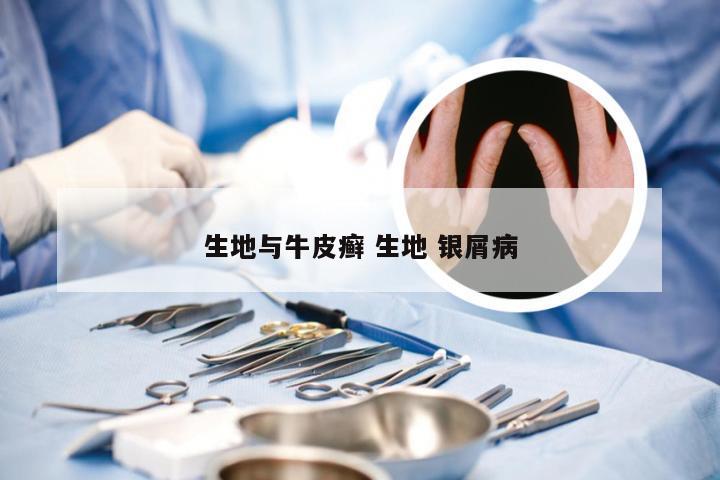 生地与牛皮癣 生地 银屑病