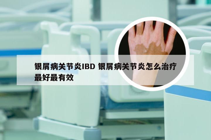 银屑病关节炎IBD 银屑病关节炎怎么治疗最好最有效