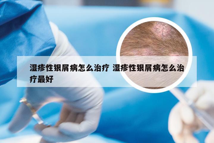 湿疹性银屑病怎么治疗 湿疹性银屑病怎么治疗最好