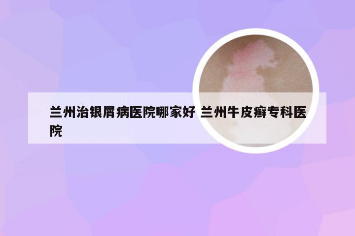 兰州治银屑病医院哪家好 兰州牛皮癣专科医院
