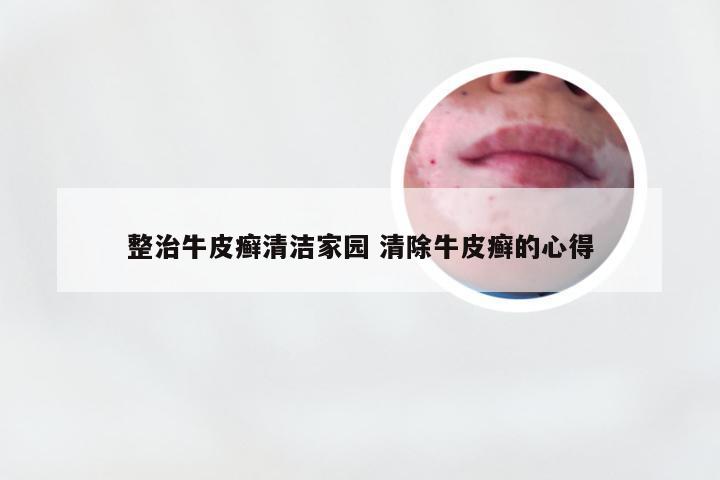 整治牛皮癣清洁家园 清除牛皮癣的心得