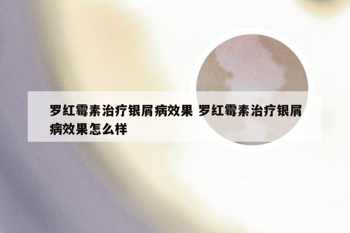 罗红霉素治疗银屑病效果 罗红霉素治疗银屑病效果怎么样