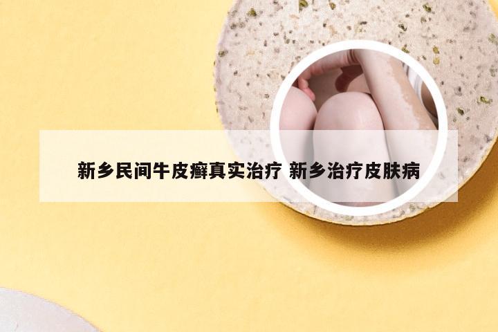 新乡民间牛皮癣真实治疗 新乡治疗皮肤病