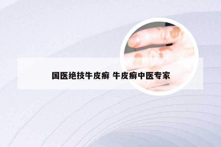 国医绝技牛皮癣 牛皮癣中医专家