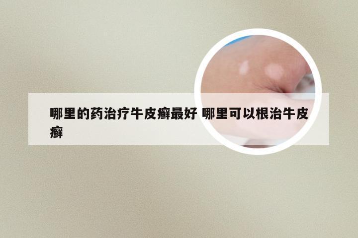 哪里的药治疗牛皮癣最好 哪里可以根治牛皮癣
