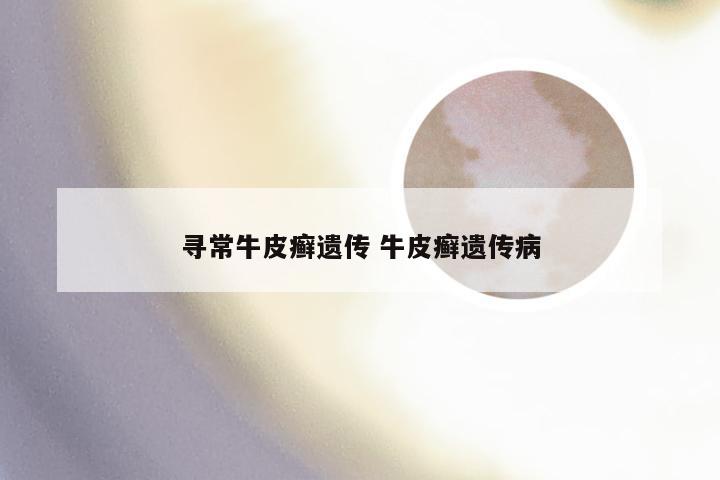 寻常牛皮癣遗传 牛皮癣遗传病