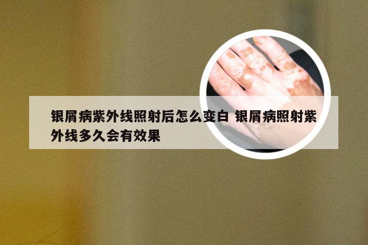 银屑病紫外线照射后怎么变白 银屑病照射紫外线多久会有效果