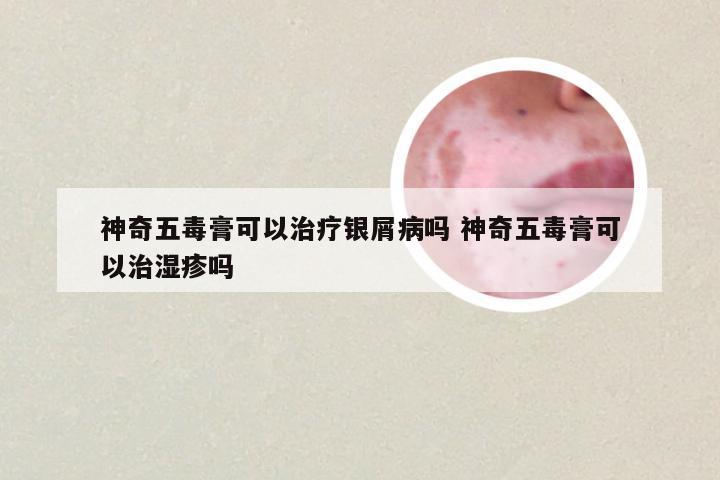 神奇五毒膏可以治疗银屑病吗 神奇五毒膏可以治湿疹吗
