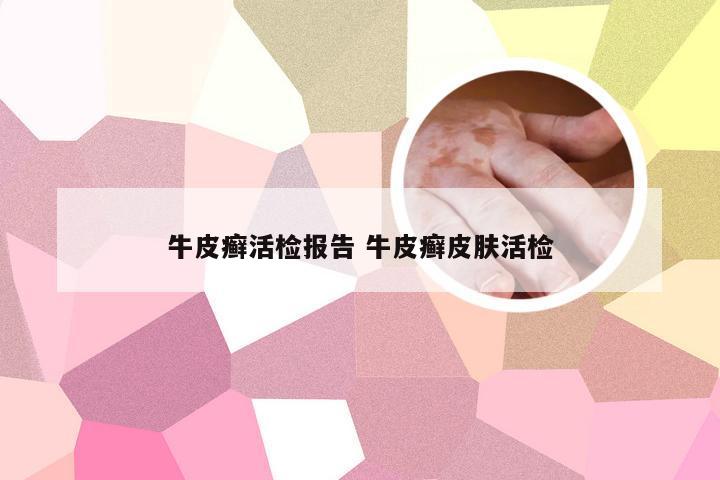 牛皮癣活检报告 牛皮癣皮肤活检