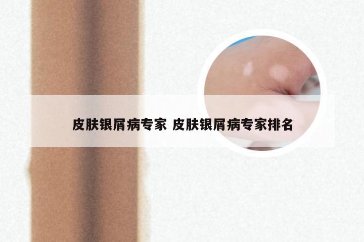 皮肤银屑病专家 皮肤银屑病专家排名