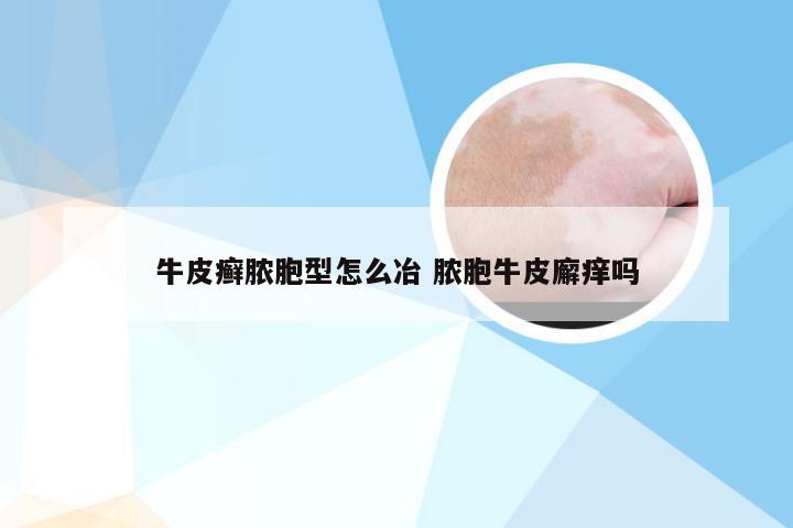 牛皮癣脓胞型怎么冶 脓胞牛皮廨痒吗
