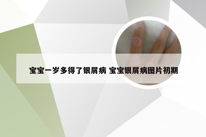 宝宝一岁多得了银屑病 宝宝银屑病图片初期